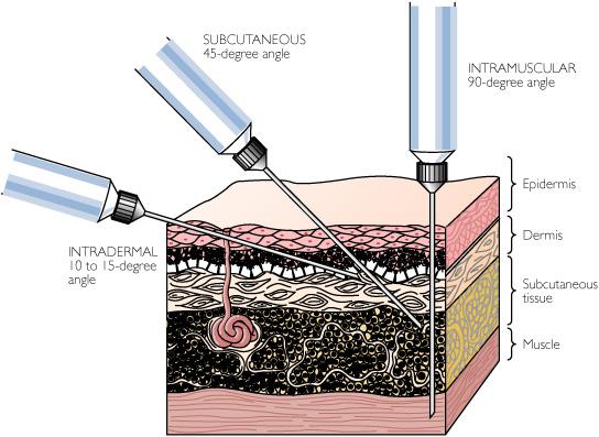 where to inject Testosterone