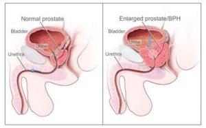 pictures of prostate cancer 3 300x186 8211