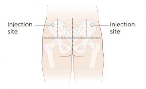 do not inject testosterone into nerves - avoid