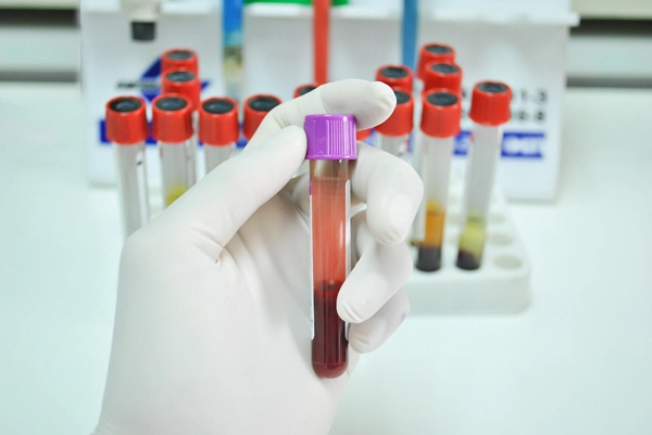 doctor holds test tube of blood in white gloves