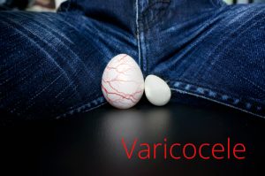 testicle shrinkage varicocele disease 300x199