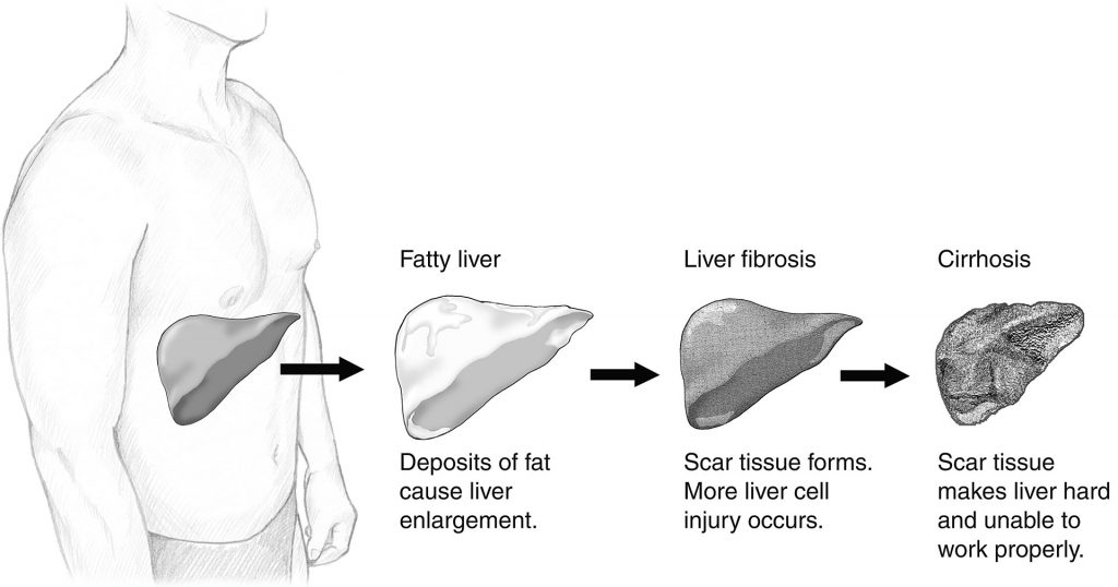 Low Testosterone Linked to NonAlcoholic Fatty Liver Disease
