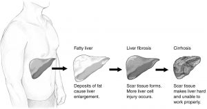 NAFLD 300x158