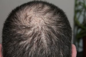 stress is main factor behind hair loss 300x200